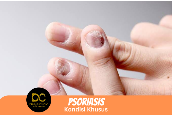 Kuku dengan pitting atau gelombang (Psoriasis Kuku)