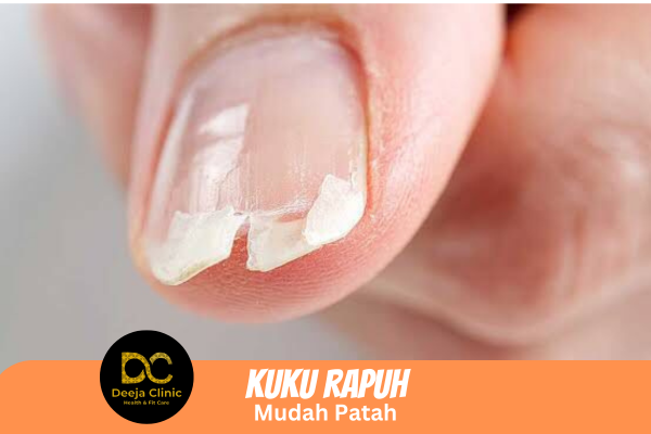 Kuku kering dan mudah patah