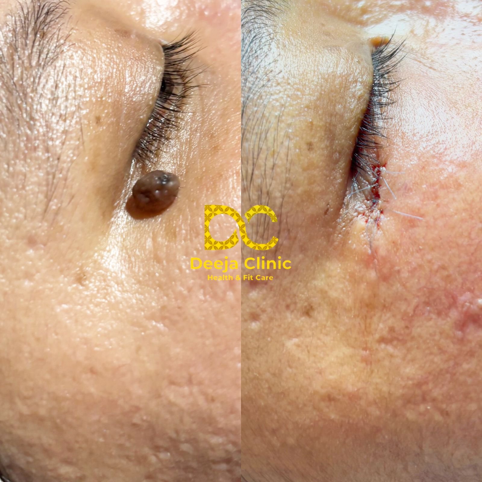 Hasil Treatment Tahi Lalat 1