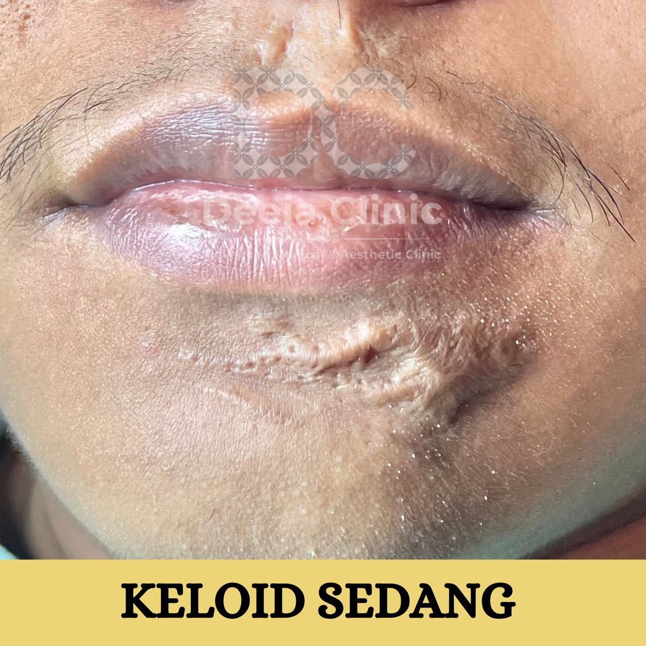Contoh kasus keloid sedang